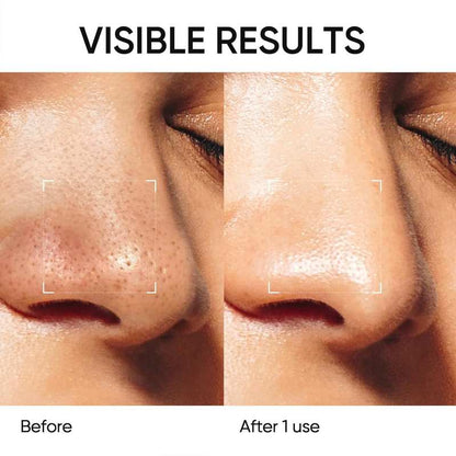 Clear Blackheads & Shrink Pores in 10 Minutes—Mess-Free!