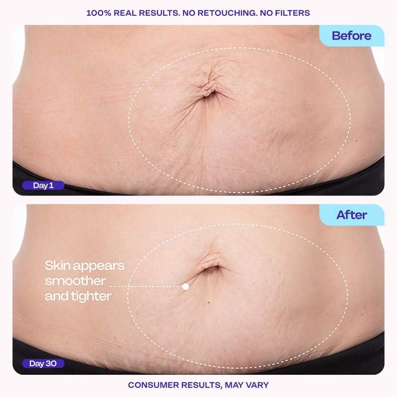 Tighten, Firm & Smooth Loose Belly Skin Instantly